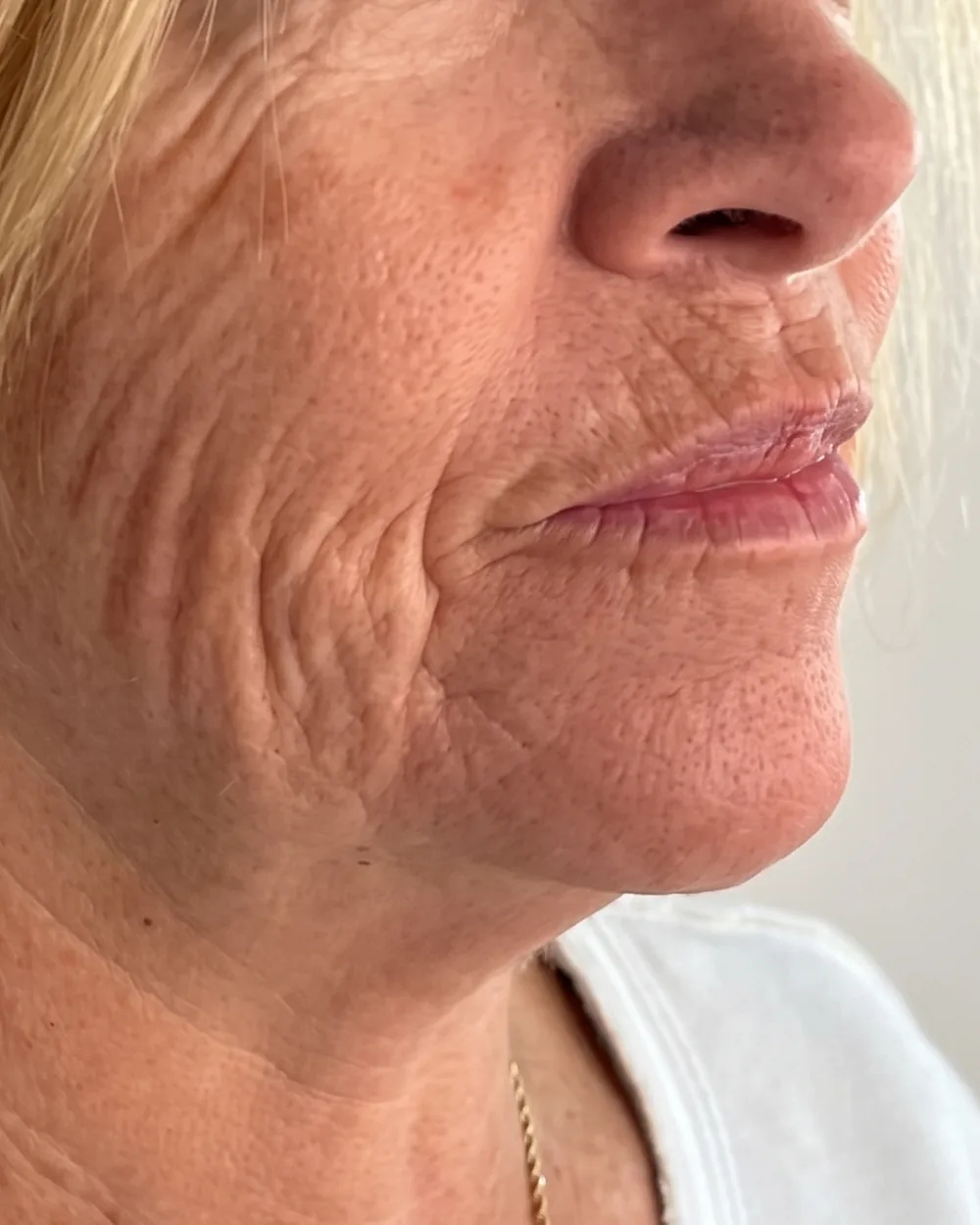 Photograph before treatment, day 0